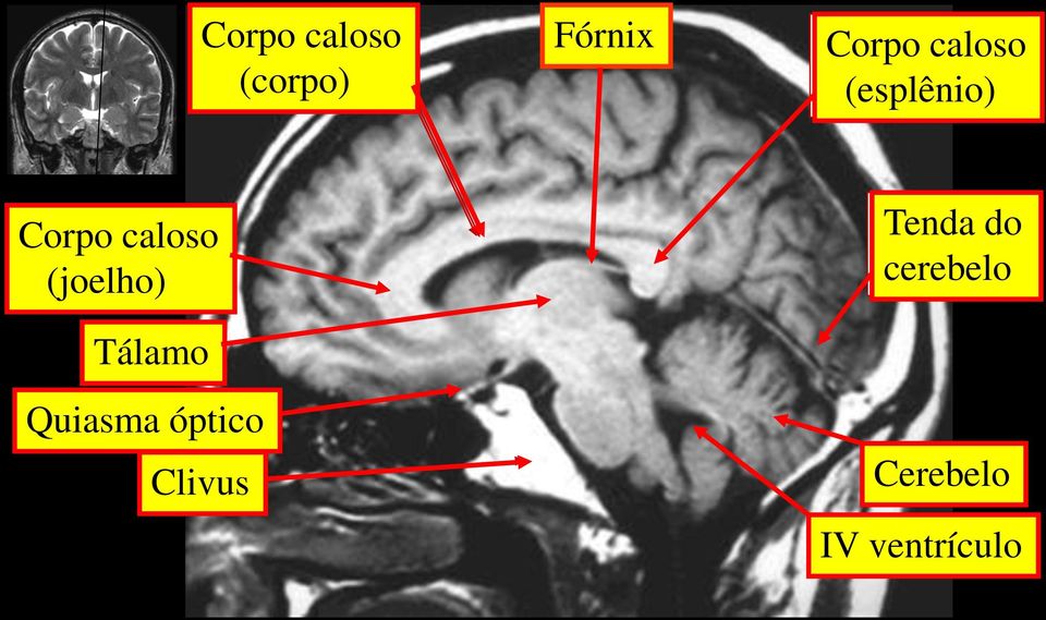 (joelho) Tálamo Quiasma óptico