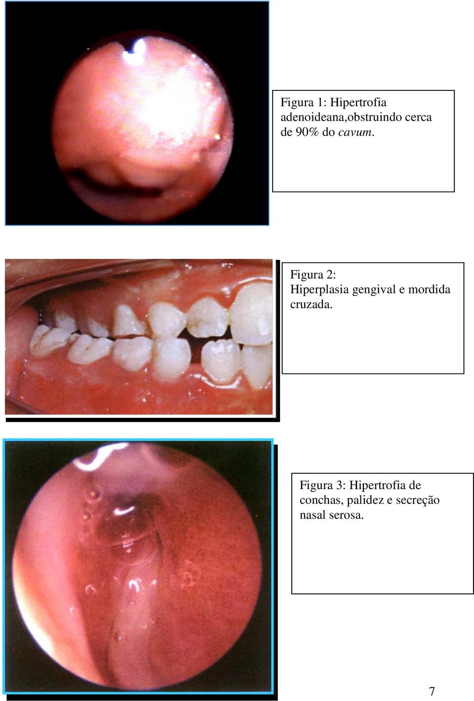 Figura 2: Hiperplasia gengival e mordida