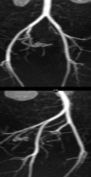 Figura 8 No topograma, banda de saturação caudal, elimina o sinal do fluxo arterial. MIP em várias projeções no plano sagital.