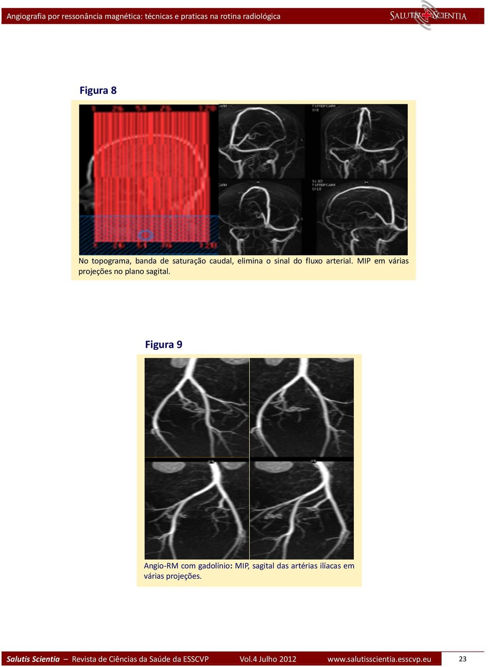 Figura 9 Angio-RM com gadolínio: MIP, sagital das artérias ilíacas em várias
