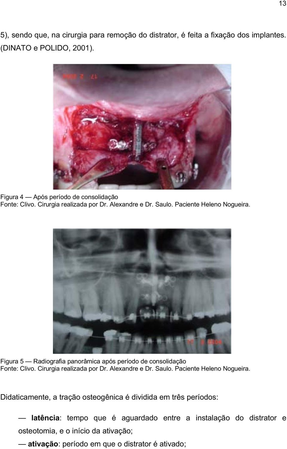 Figura 5 Radiografia panorâmica após período de consolidação Fonte: Clivo. Cirurgia realizada por Dr. Alexandre e Dr. Saulo. Paciente Heleno Nogueira.