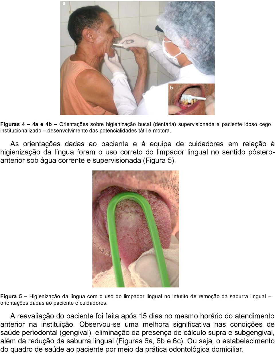 (Figura 5). Figura 5 Higienização da língua com o uso do limpador lingual no intutito de remoção da saburra lingual orientações dadas ao paciente e cuidadores.
