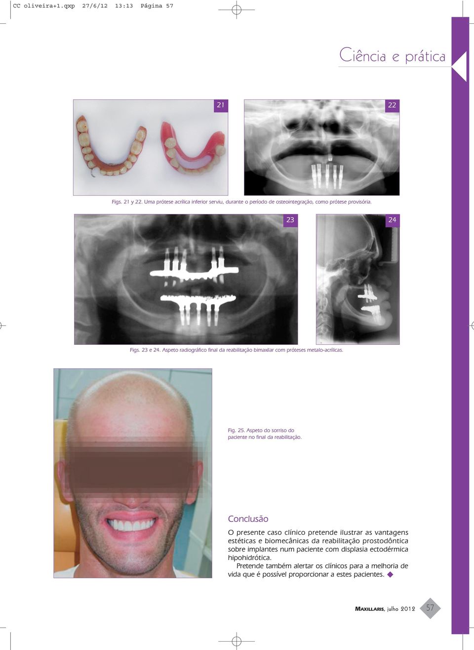 Aspeto radiográfico final da reabilitação bimaxilar com próteses metalo-acrílicas. Fig. 25. Aspeto do sorriso do paciente no final da reabilitação.