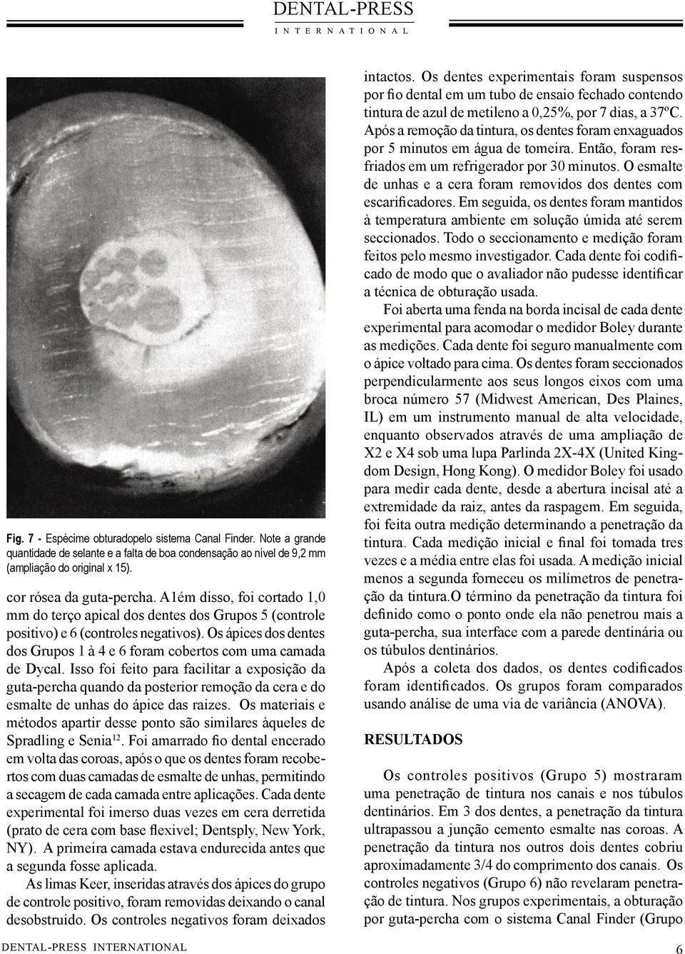 Isso foi feito para facilitar a exposição da guta-percha quando da posterior remoção da cera e do esmalte de unhas do ápice das raizes.