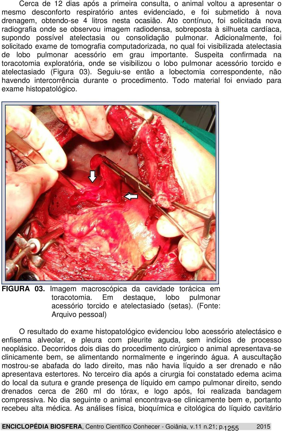 Adicionalmente, foi solicitado exame de tomografia computadorizada, no qual foi visibilizada atelectasia de lobo pulmonar acessório em grau importante.