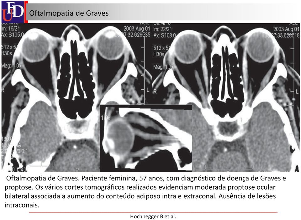 proptose.