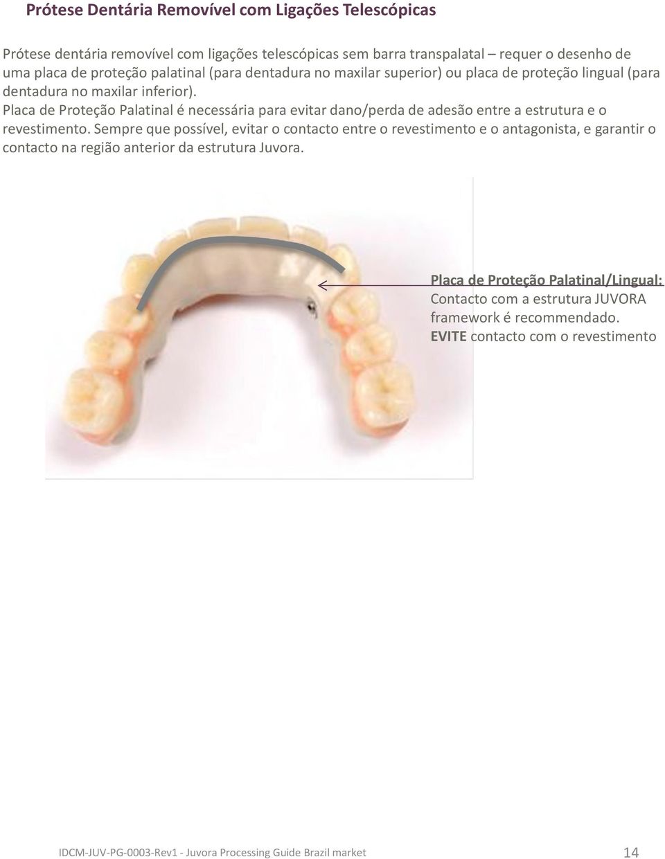 Placa de ProteçãoPalatinal é necessária para evitar dano/perda de adesão entre a estrutura e o revestimento.