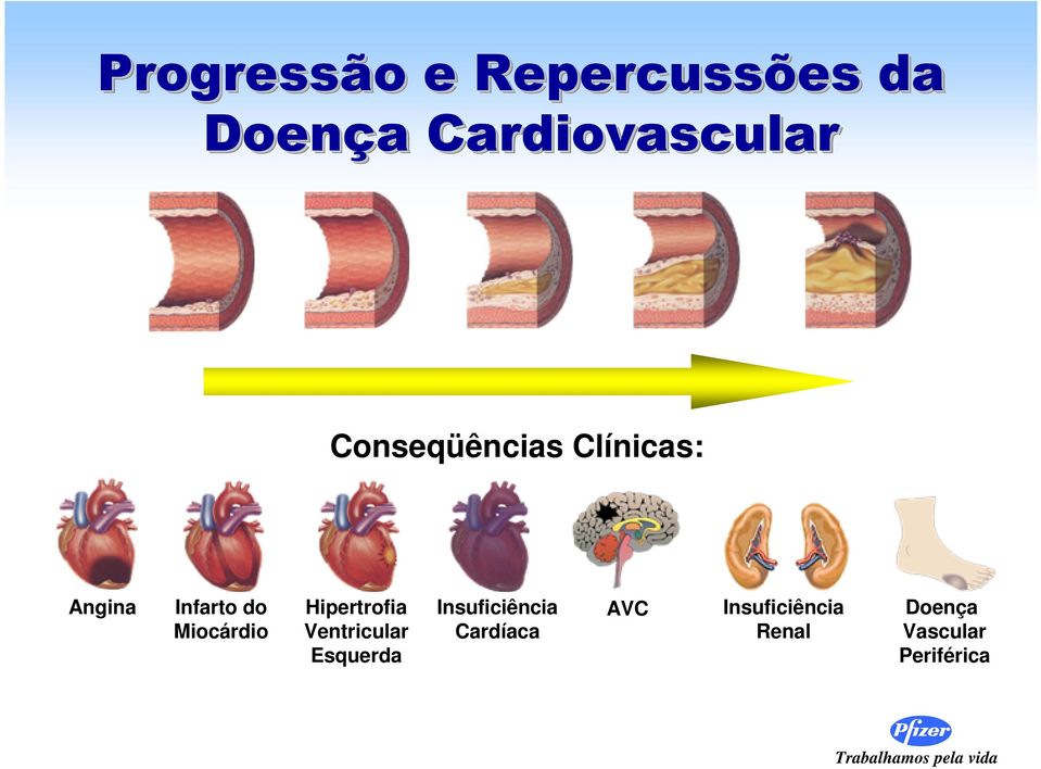 Hipertrofia Ventricular Esquerda Insuficiência