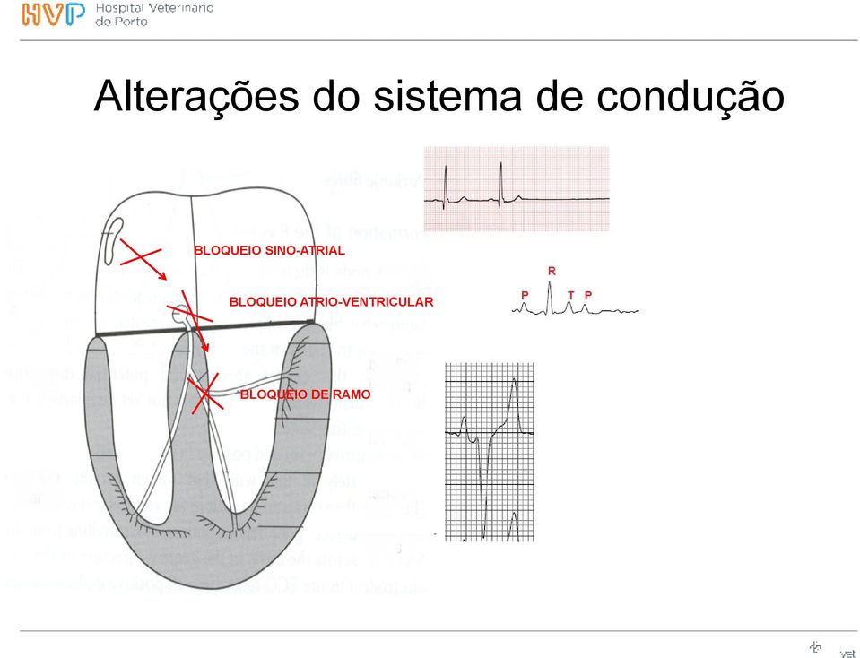 SINO-ATRIAL BLOQUEIO