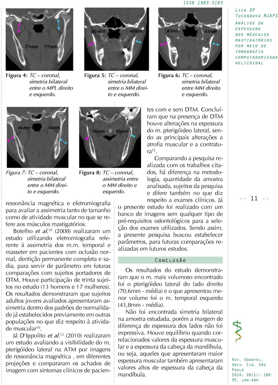 10 (2008) realizaram um estudo utilizando eletromiografia referente à assimetria dos m.m. temporal e masseter em pacientes com oclusão normal, dentição permanente completa e sadia, para servir de parâmetro em futuras comparações com sujeitos portadores de DTM.