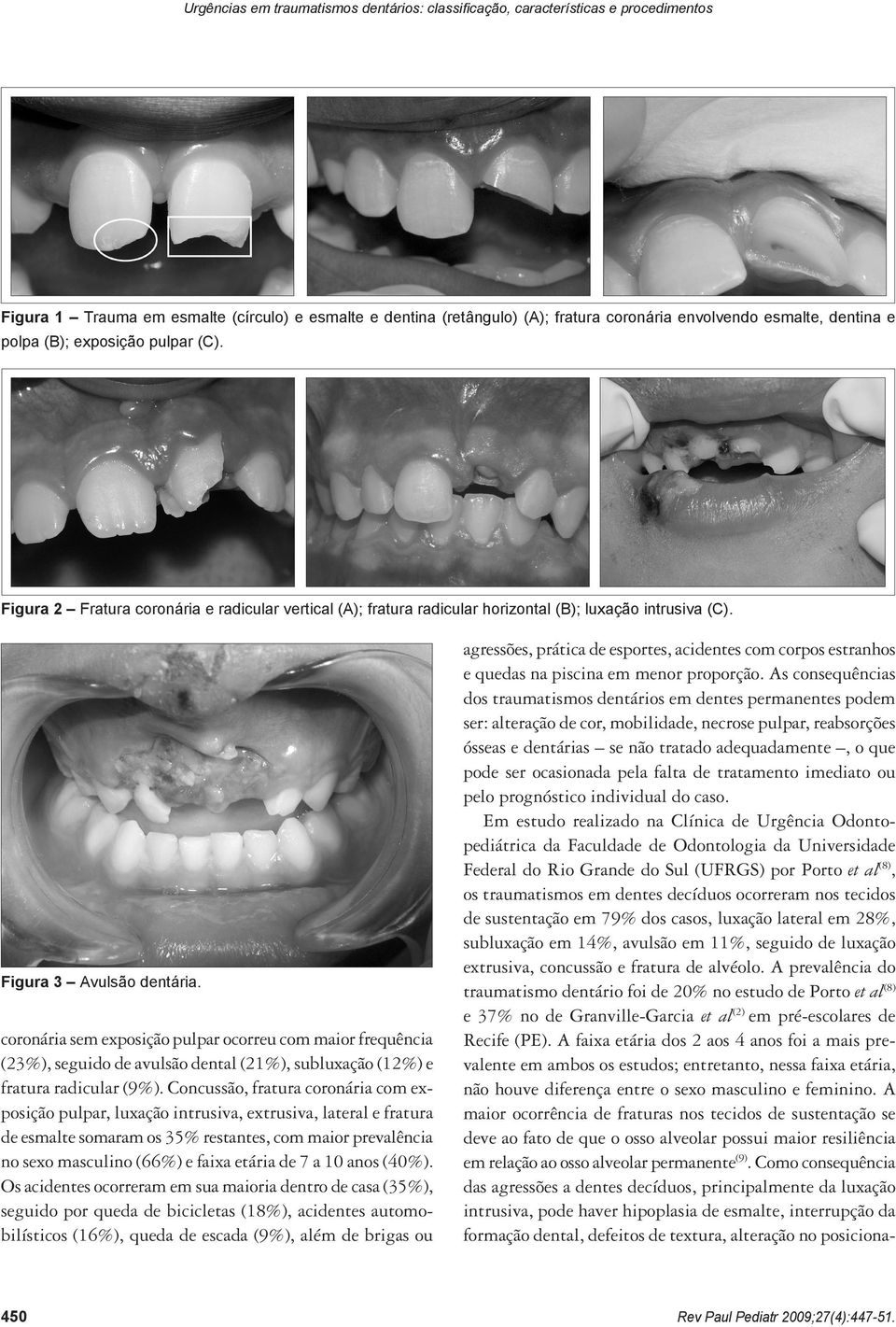 coronária sem exposição pulpar ocorreu com maior frequência (23%), seguido de avulsão dental (21%), subluxação (12%) e fratura radicular (9%).