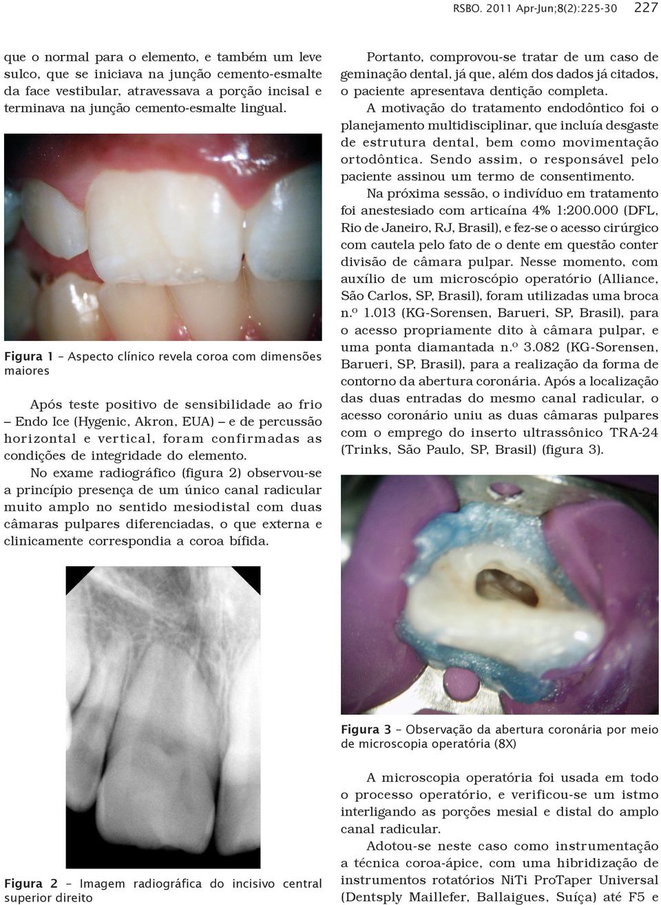 Figura 1 Aspecto clínico revela coroa com dimensões maiores Após teste positivo de sensibilidade ao frio Endo Ice (Hygenic, Akron, EUA) e de percussão horizonta l e vertica l, fora m confirmadas as