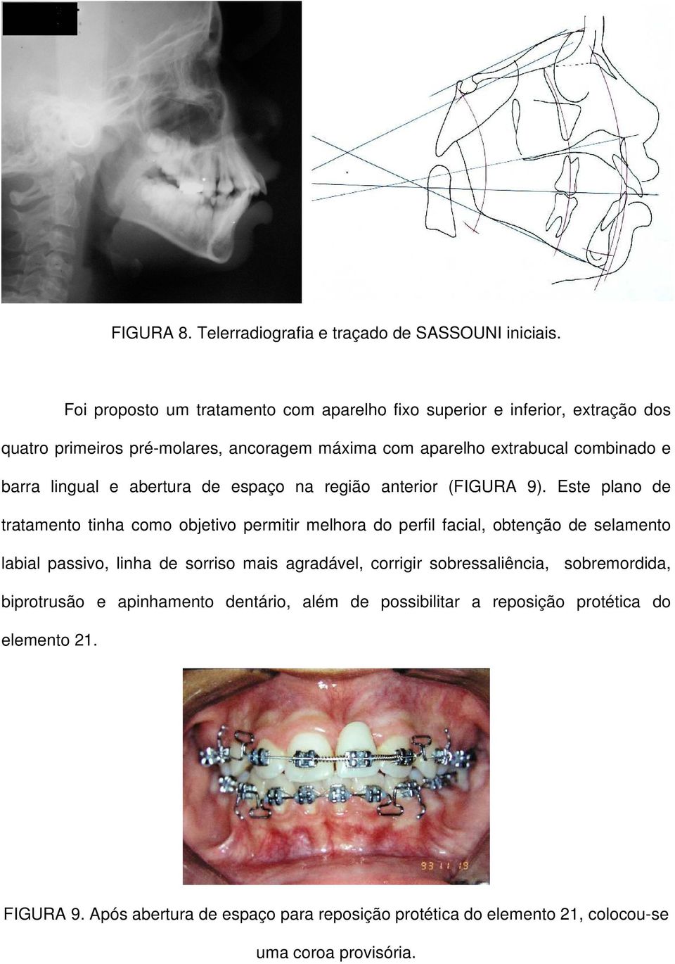 lingual e abertura de espaço na região anterior (FIGURA 9).