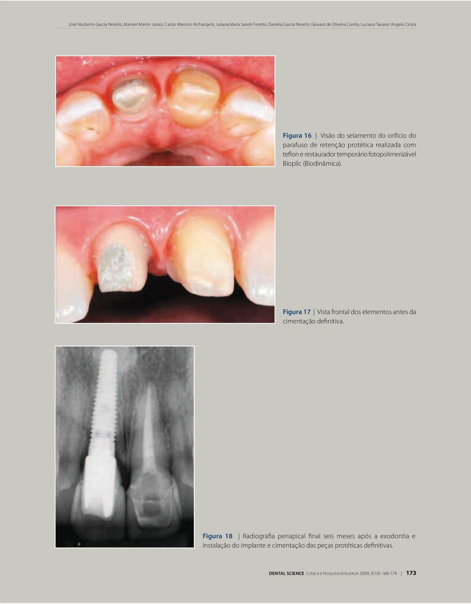 temporário fotopolimerizável Bioplic (Biodinâmica). Figura 17 Vista frontal dos elementos antes da cimentação definitiva.