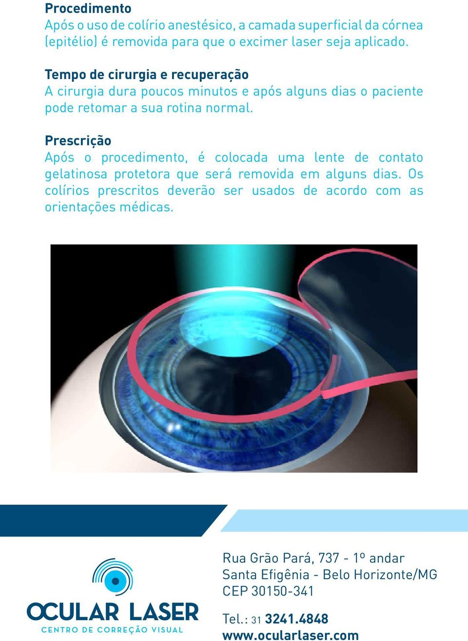 Prescrição Após o procedimento, é colocada uma lente de contato gelatinosa protetora que será removida em alguns dias.