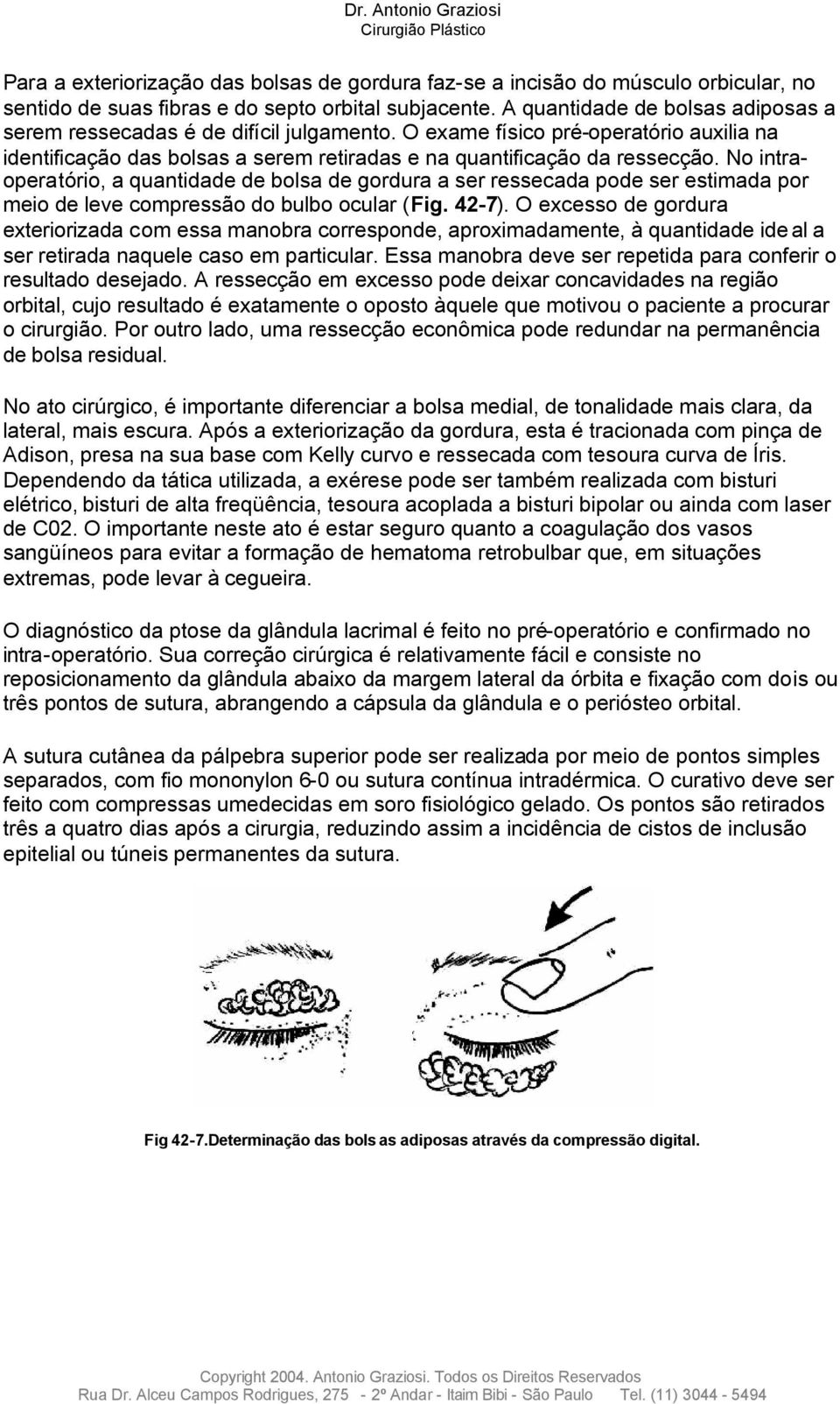 No intraoperatório, a quantidade de bolsa de gordura a ser ressecada pode ser estimada por meio de leve compressão do bulbo ocular (Fig. 42-7).