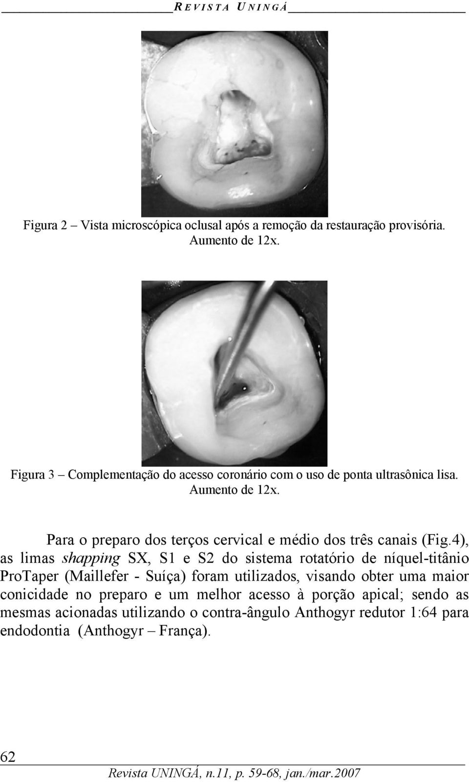 Para o preparo dos terços cervical e médio dos três canais (Fig.