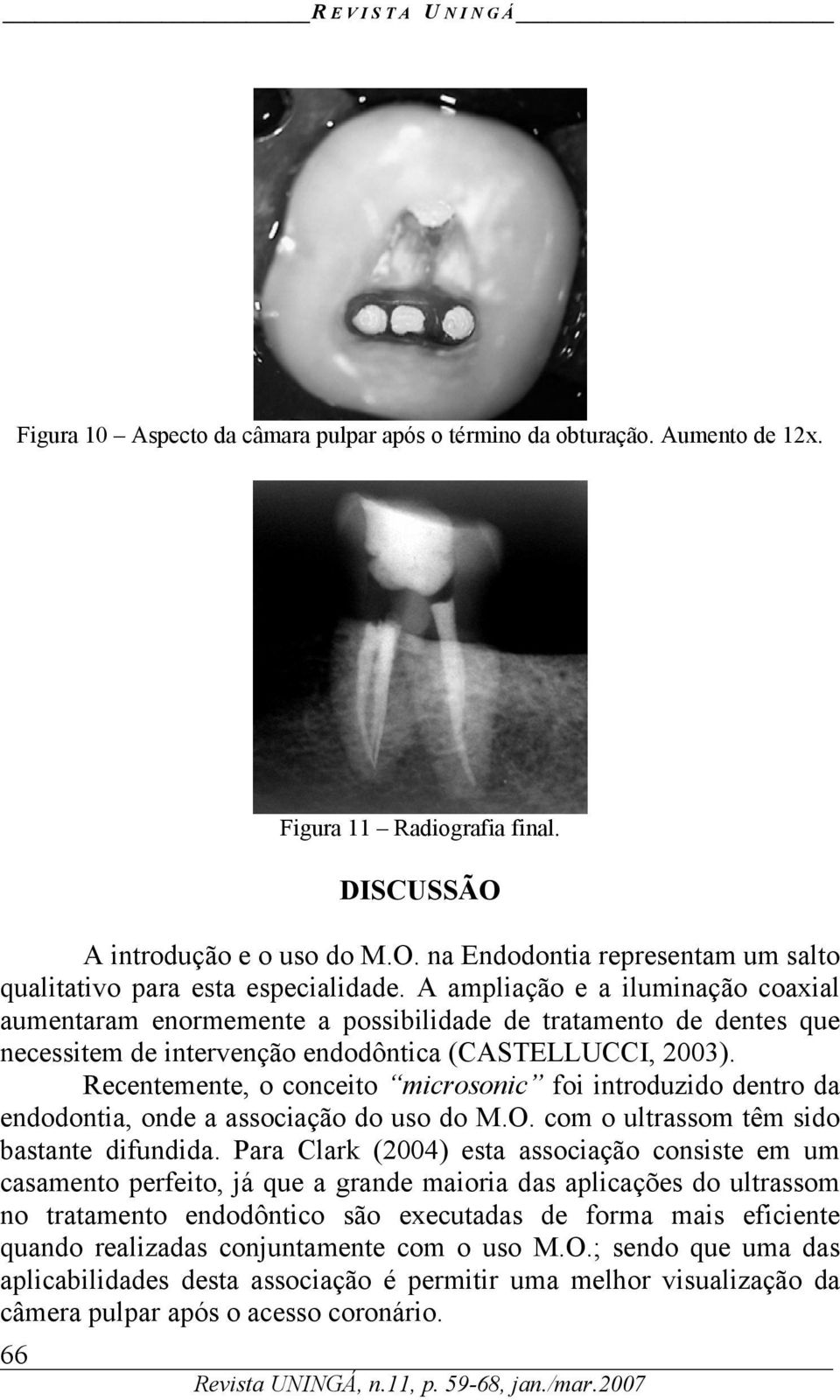 Recentemente, o conceito microsonic foi introduzido dentro da endodontia, onde a associação do uso do M.O. com o ultrassom têm sido bastante difundida.