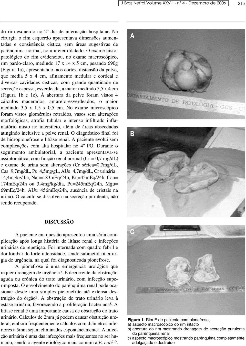 O exame histopatológico do rim evidenciou, no exame macroscópico, rim pardo-claro, medindo 17 x 14 x 5 cm, pesando 690g (Figura 1a), apresentando, aos cortes, distensão da pelve, que media 5 x 4 cm,