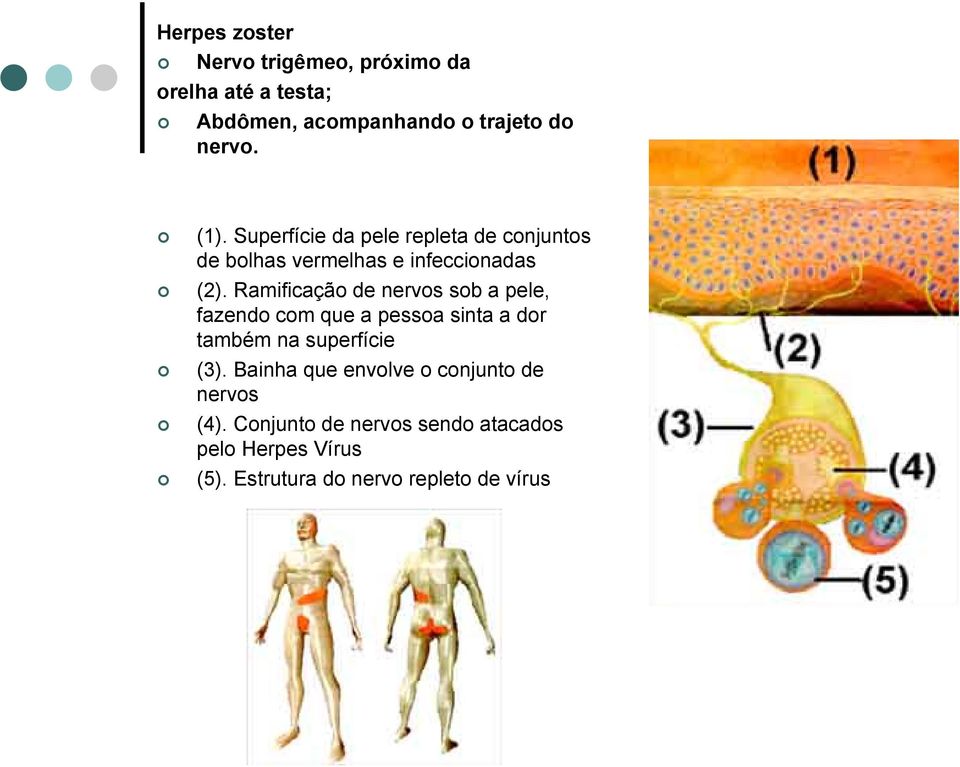 Ramificação de nervos sob a pele, fazendo com que a pessoa sinta a dor também na superfície (3).