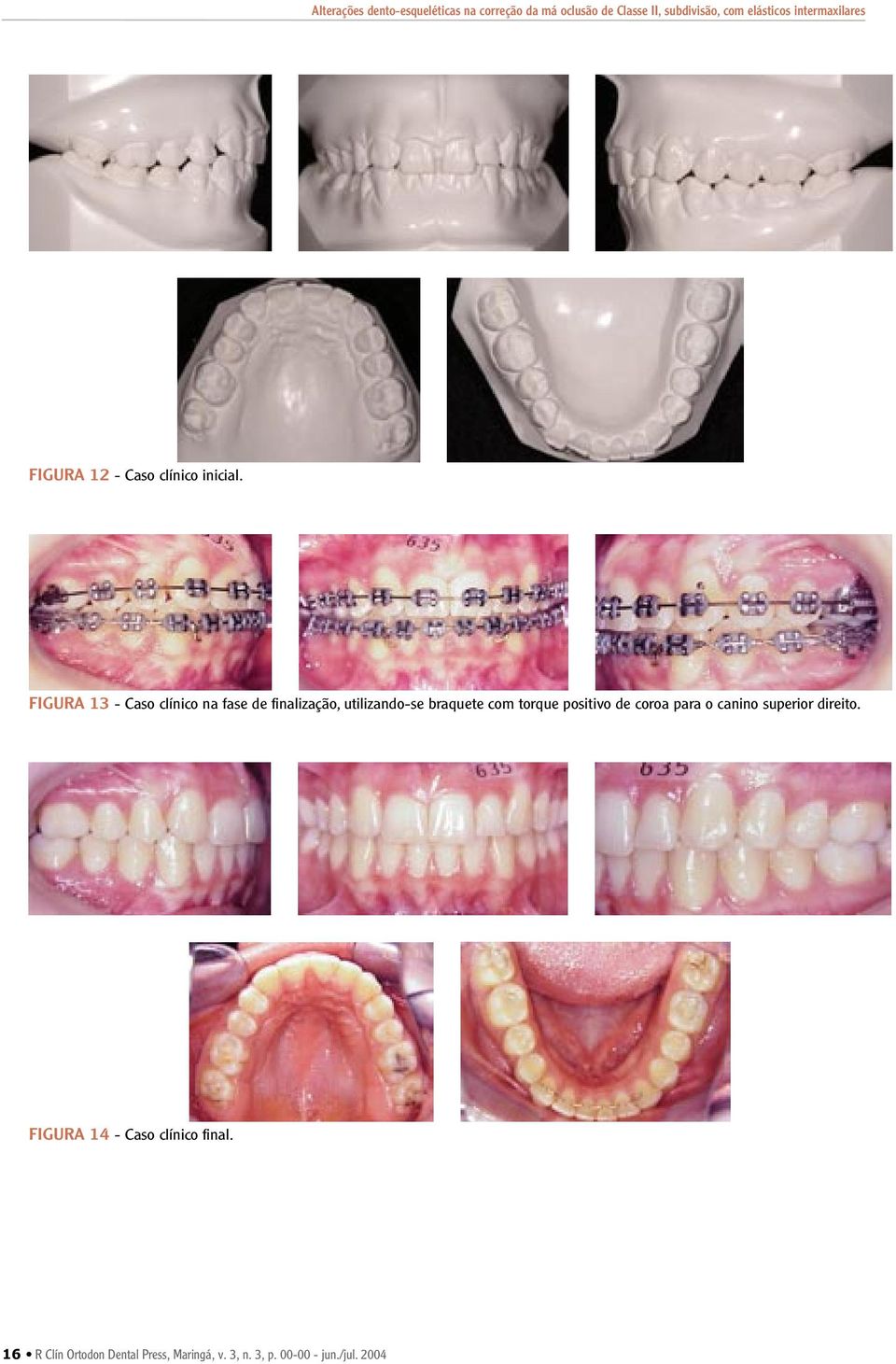 braquete com torque positivo de coroa para o canino superior direito.