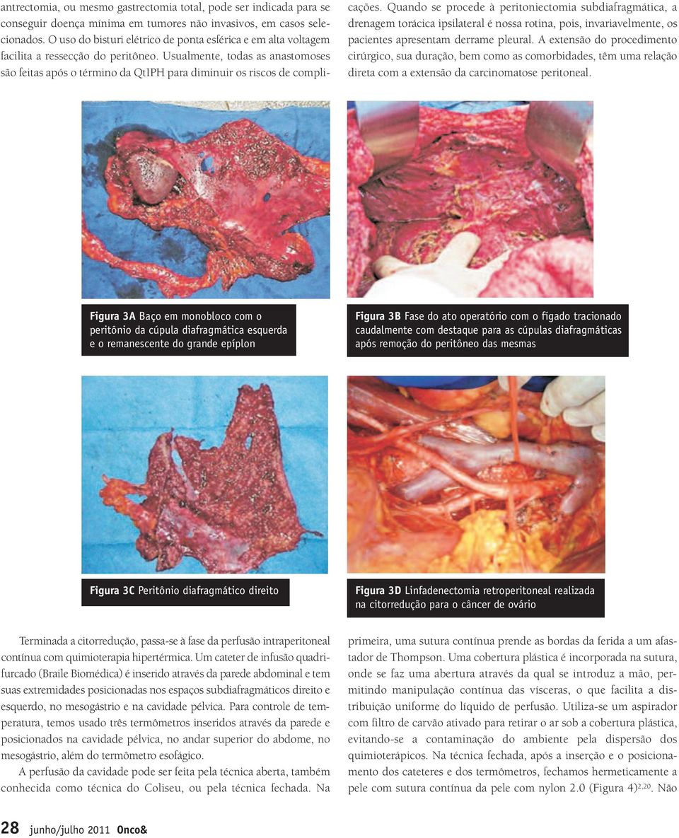 Usualmente, todas as anastomoses são feitas após o término da QtIPH para diminuir os riscos de complicações.