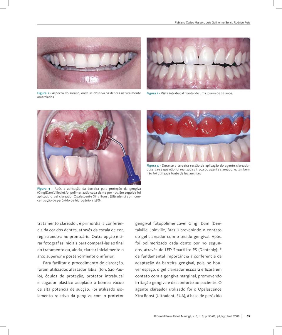 Figura 3 - Após a aplicação da barreira para proteção da gengiva (GingiDam,Villevie),foi polimerizado cada dente por 10s.