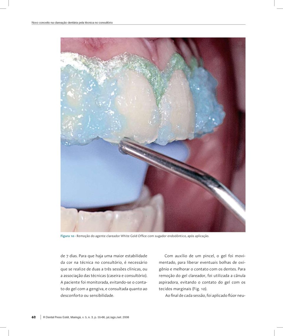 A paciente foi monitorada, evitando-se o contato do gel com a gengiva, e consultada quanto ao desconforto ou sensibilidade.