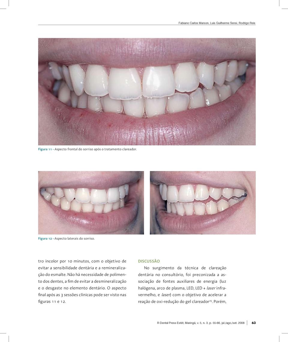 Não há necessidade de polimento dos dentes, a fim de evitar a desmineralização e o desgaste no elemento dentário. O aspecto final após as 3 sessões clínicas pode ser visto nas figuras 11 e 12.