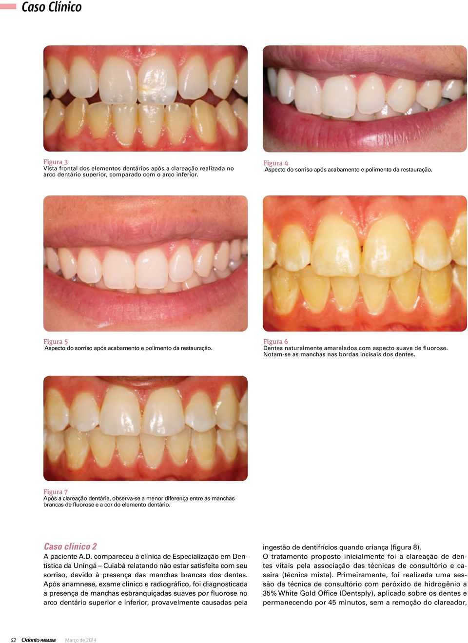 Figura 6 Dentes naturalmente amarelados com aspecto suave de fluorose. Notam-se as manchas nas bordas incisais dos dentes.