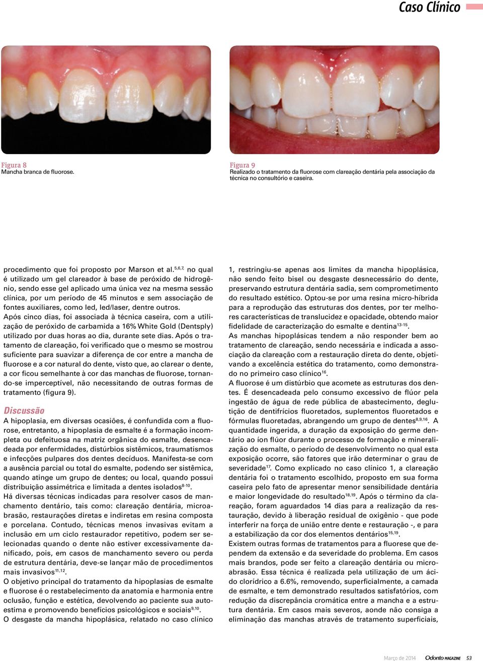 5,6,7, no qual é utilizado um gel clareador à base de peróxido de hidrogênio, sendo esse gel aplicado uma única vez na mesma sessão clínica, por um período de 45 minutos e sem associação de fontes