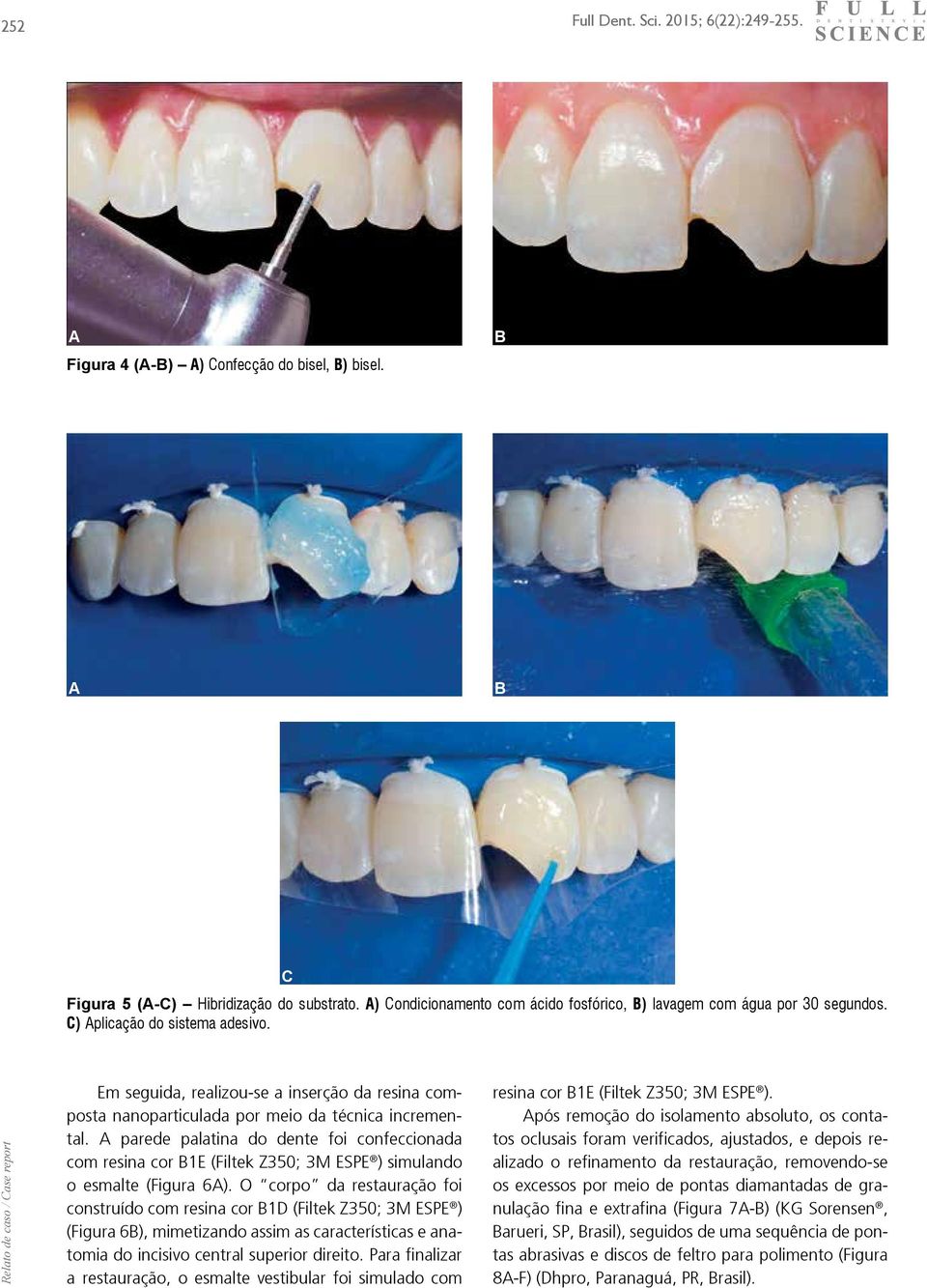 A prede pltin do dente foi confecciond com resin cor 1E (Filtek Z350; 3M ESPE ) simulndo o esmlte (Figur 6A).