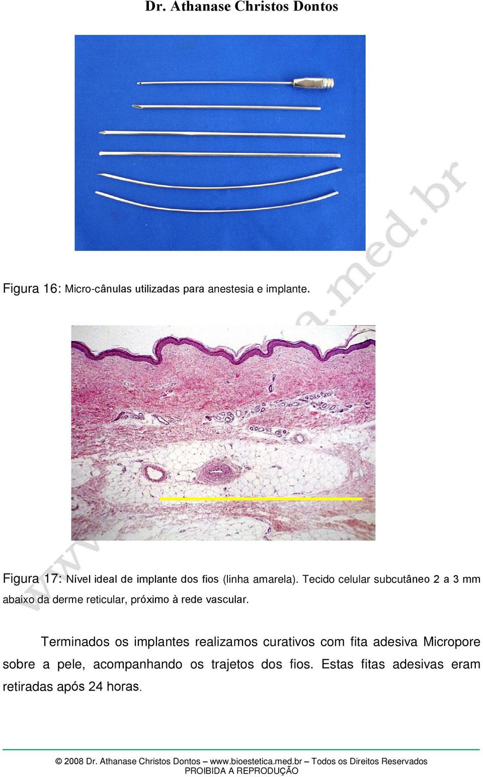 Tecido celular subcutâneo 2 a 3 mm abaixo da derme reticular, próximo à rede vascular.