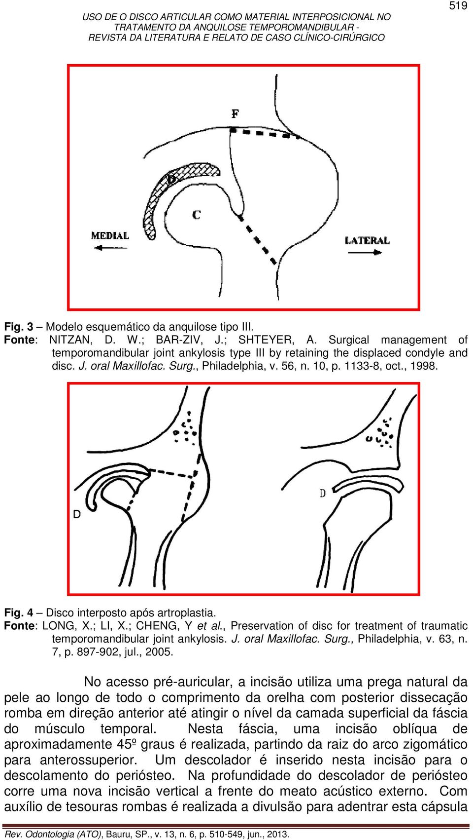 4 Disco interposto após artroplastia. Fonte: LONG, X.; LI, X.; CHENG, Y et al., Preservation of disc for treatment of traumatic temporomandibular joint ankylosis. J. oral Maxillofac. Surg.