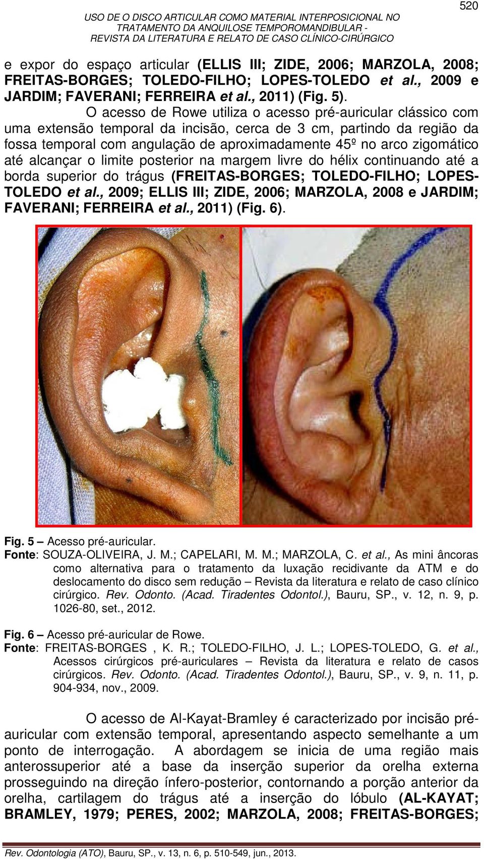 zigomático até alcançar o limite posterior na margem livre do hélix continuando até a borda superior do trágus (FREITAS-BORGES; TOLEDO-FILHO; LOPES- TOLEDO et al.