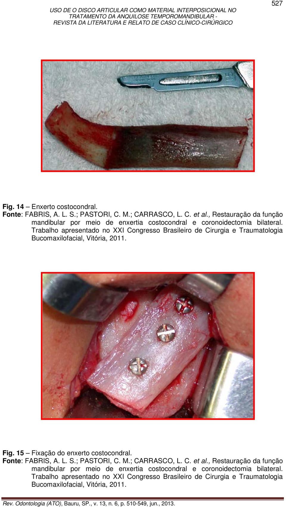 Trabalho apresentado no XXI Congresso Brasileiro de Cirurgia e Traumatologia Bucomaxilofacial, Vitória, 2011. Fig. 15 Fixação do enxerto costocondral.