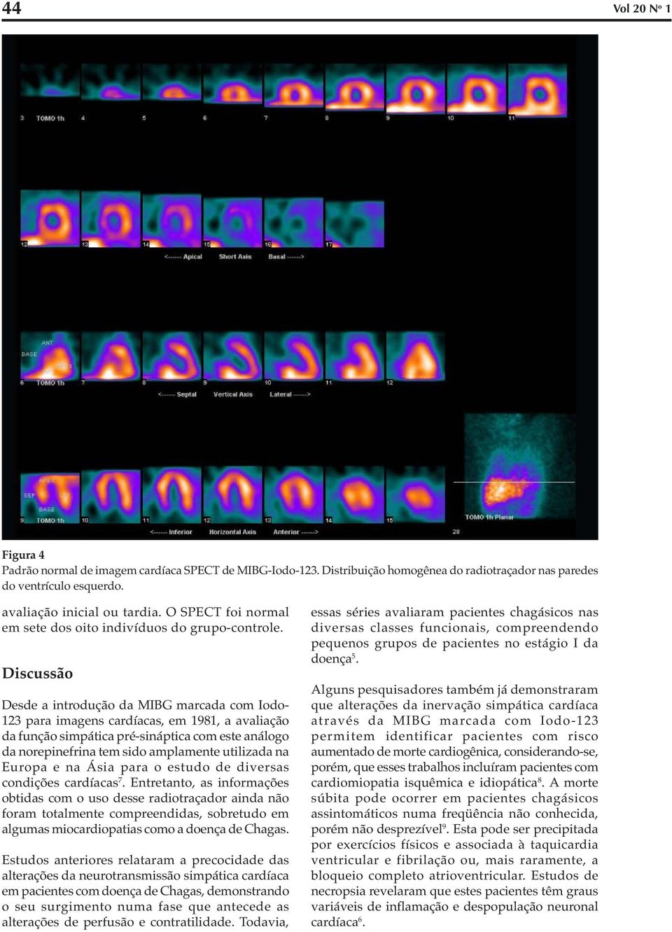 Discussão Desde a introdução da MIBG marcada com Iodo- 123 para imagens cardíacas, em 1981, a avaliação da função simpática pré-sináptica com este análogo da norepinefrina tem sido amplamente