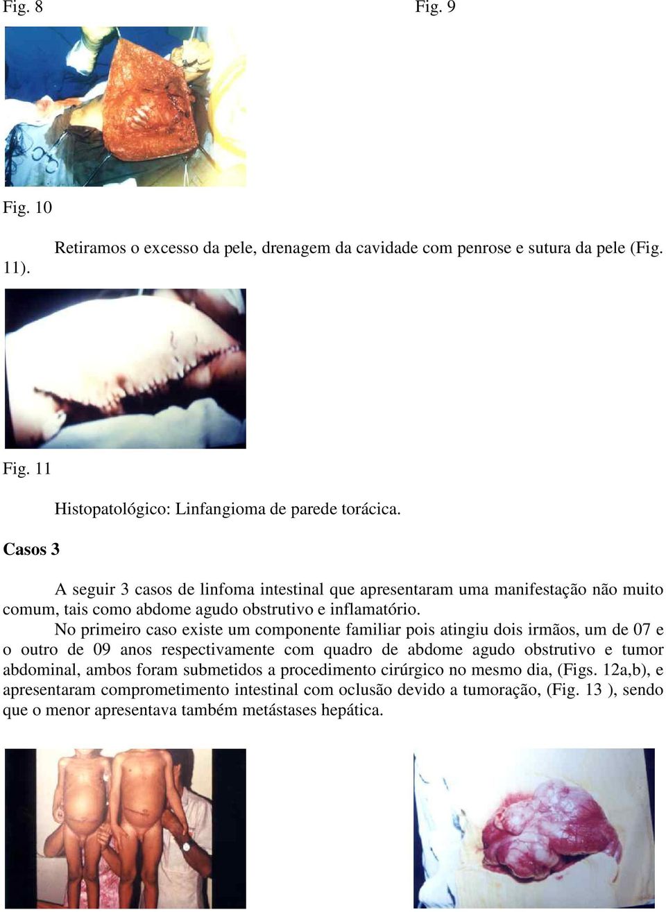 No primeiro caso existe um componente familiar pois atingiu dois irmãos, um de 07 e o outro de 09 anos respectivamente com quadro de abdome agudo obstrutivo e tumor abdominal,