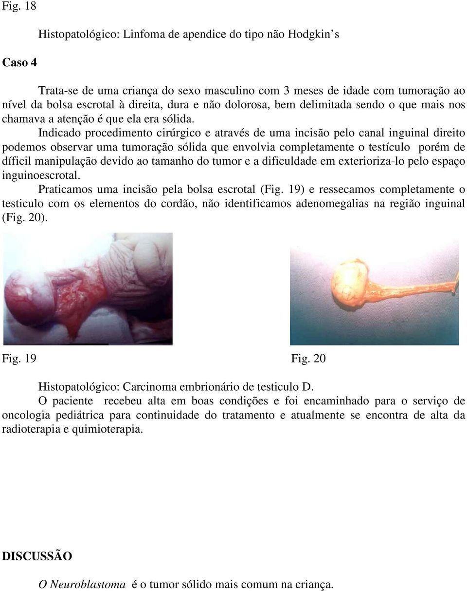 Indicado procedimento cirúrgico e através de uma incisão pelo canal inguinal direito podemos observar uma tumoração sólida que envolvia completamente o testículo porém de díficil manipulação devido