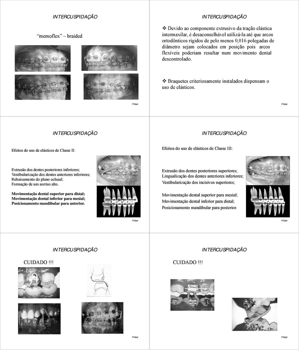 Efeitos do uso de elásticos de Classe II: Efeitos do uso de elásticos de Classe III: Extrusão dos dentes posteriores inferiores; Vestibularização dos dentes anteriores inferiores; Rebaixamento do