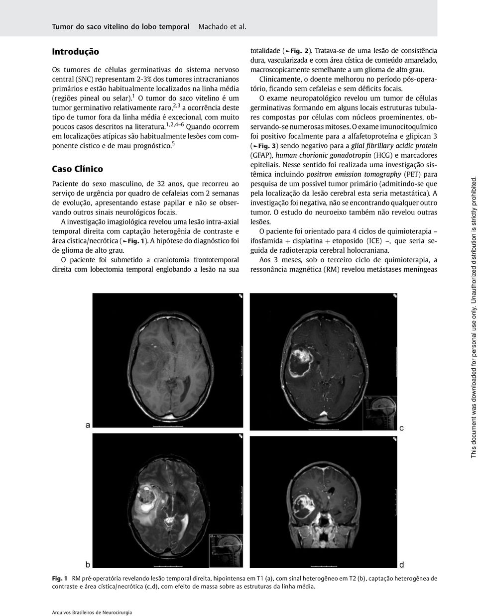 1 O tumor do saco vitelino é um tumor germinativo relativamente raro, 2,3 a ocorrência deste tipo de tumor fora da linha média é excecional, com muito poucos casos descritos na literatura.