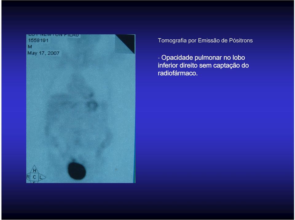 pulmonar no lobo inferior