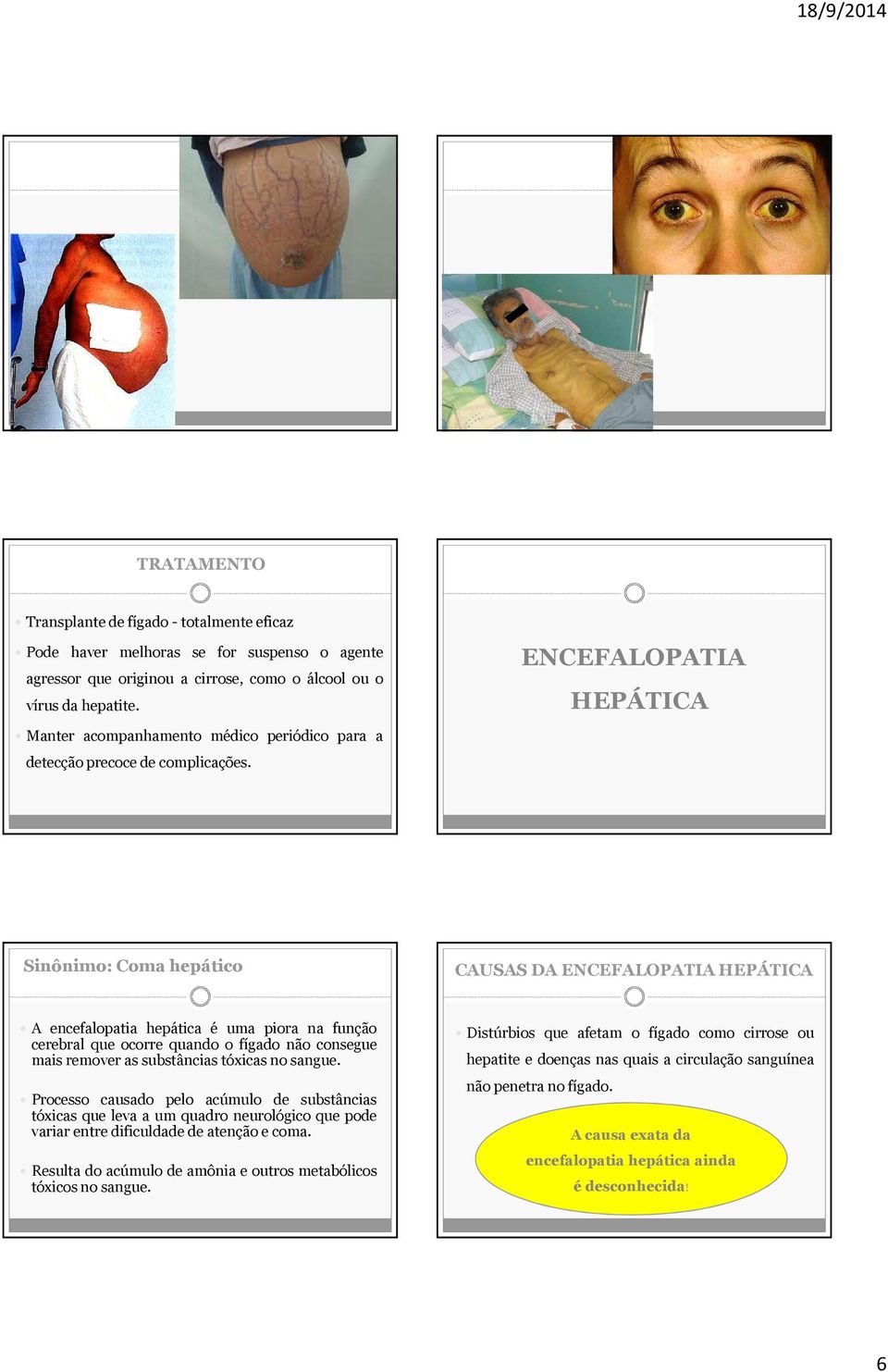 ENCEFALOPATIA HEPÁTICA Sinônimo: Coma hepático CAUSAS DA ENCEFALOPATIA HEPÁTICA A encefalopatia hepática é uma piora na função cerebral que ocorre quando o fígado não consegue mais remover as