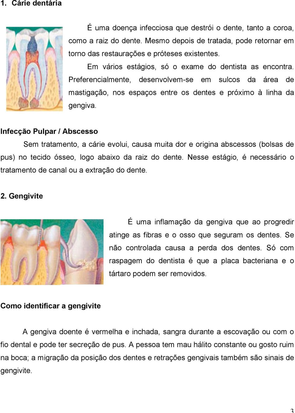 Infecção Pulpar / Abscesso Sem tratamento, a cárie evolui, causa muita dor e origina abscessos (bolsas de pus) no tecido ósseo, logo abaixo da raiz do dente.