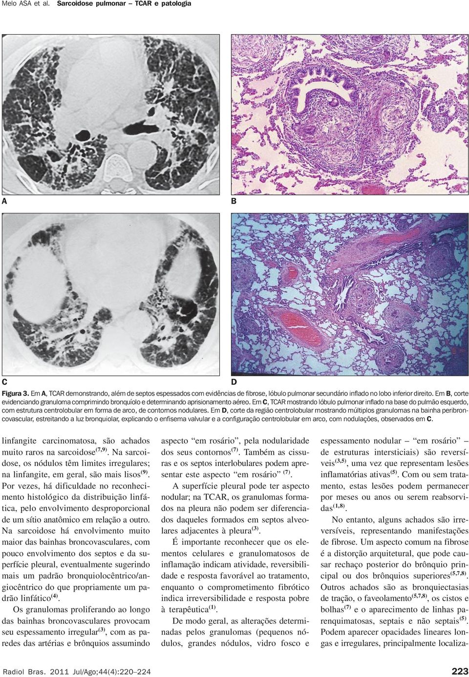 Em, TR mostrando lóbulo pulmonar inflado na base do pulmão esquerdo, com estrutura centrolobular em forma de arco, de contornos nodulares.