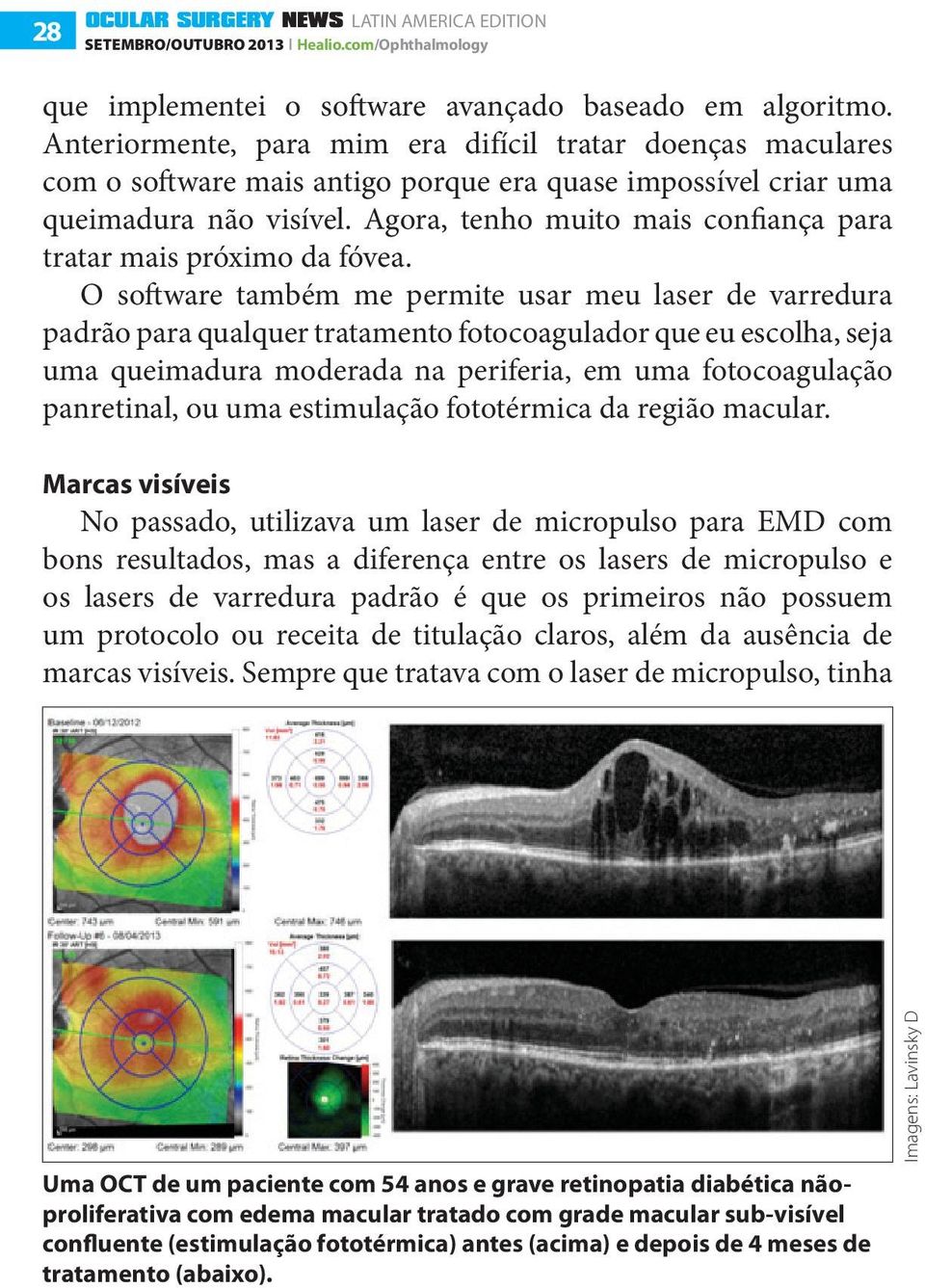 Agora, tenho muito mais confiança para tratar mais próximo da fóvea.