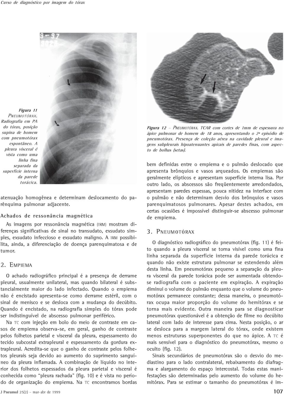 chados de ressonância magnética s imagens por ressonância magnética (IRM) mostram diferenças significativas de sinal no transudato, exsudato simples, exsudato infeccioso e exsudato maligno.