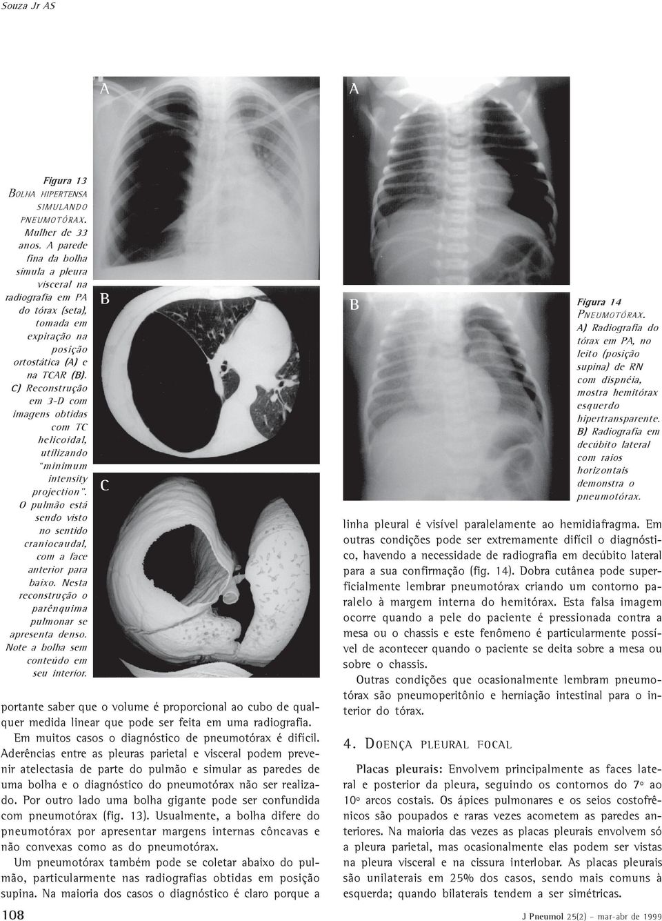 C) Reconstrução em 3-D com imagens obtidas com TC helicoidal, utilizando minimum intensity projection. O pulmão está sendo visto no sentido craniocaudal, com a face anterior para baixo.