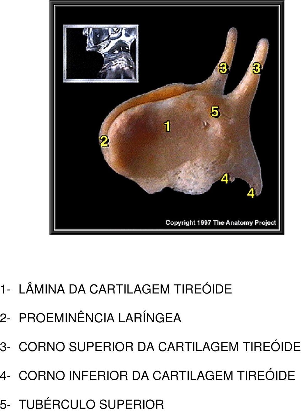 DA CARTILAGEM TIREÓIDE 4- CORNO INFERIOR