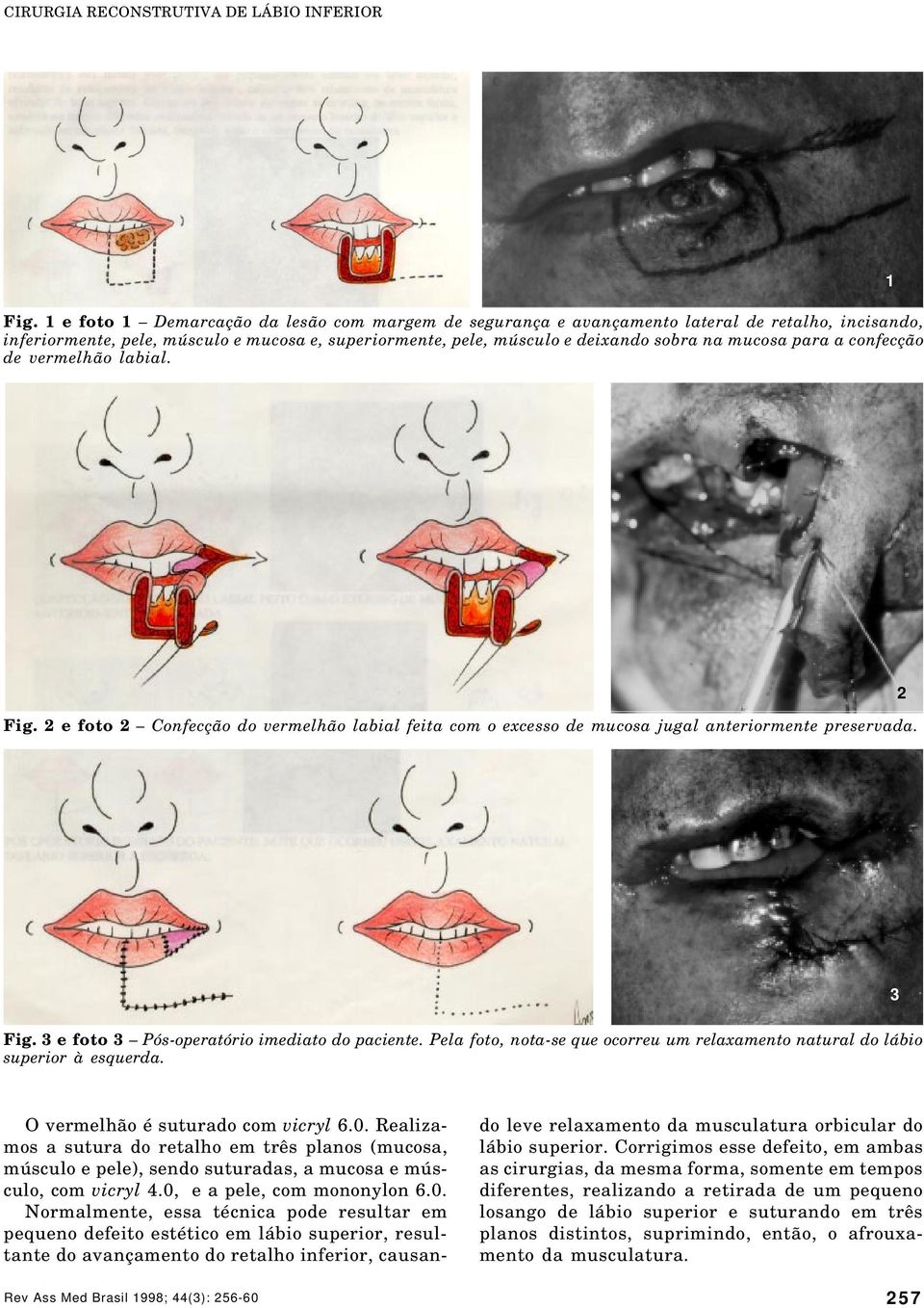para a confecção de vermelhão labial. 1 Fig. 2 e foto 2 Confecção do vermelhão labial feita com o excesso de mucosa jugal anteriormente preservada. 2 3 Fig.